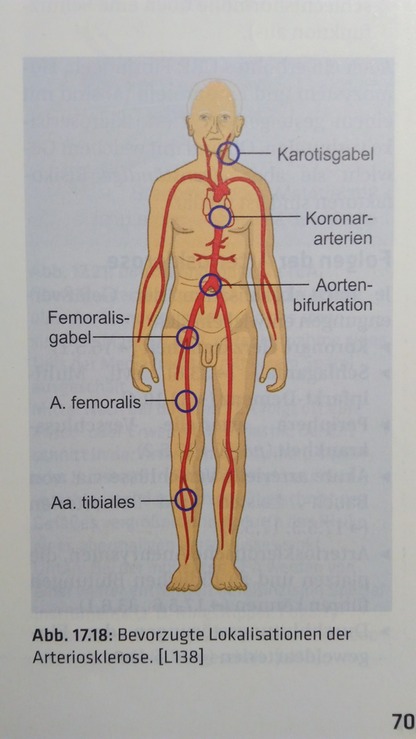Arteriosklerose Dilektionsstellen
